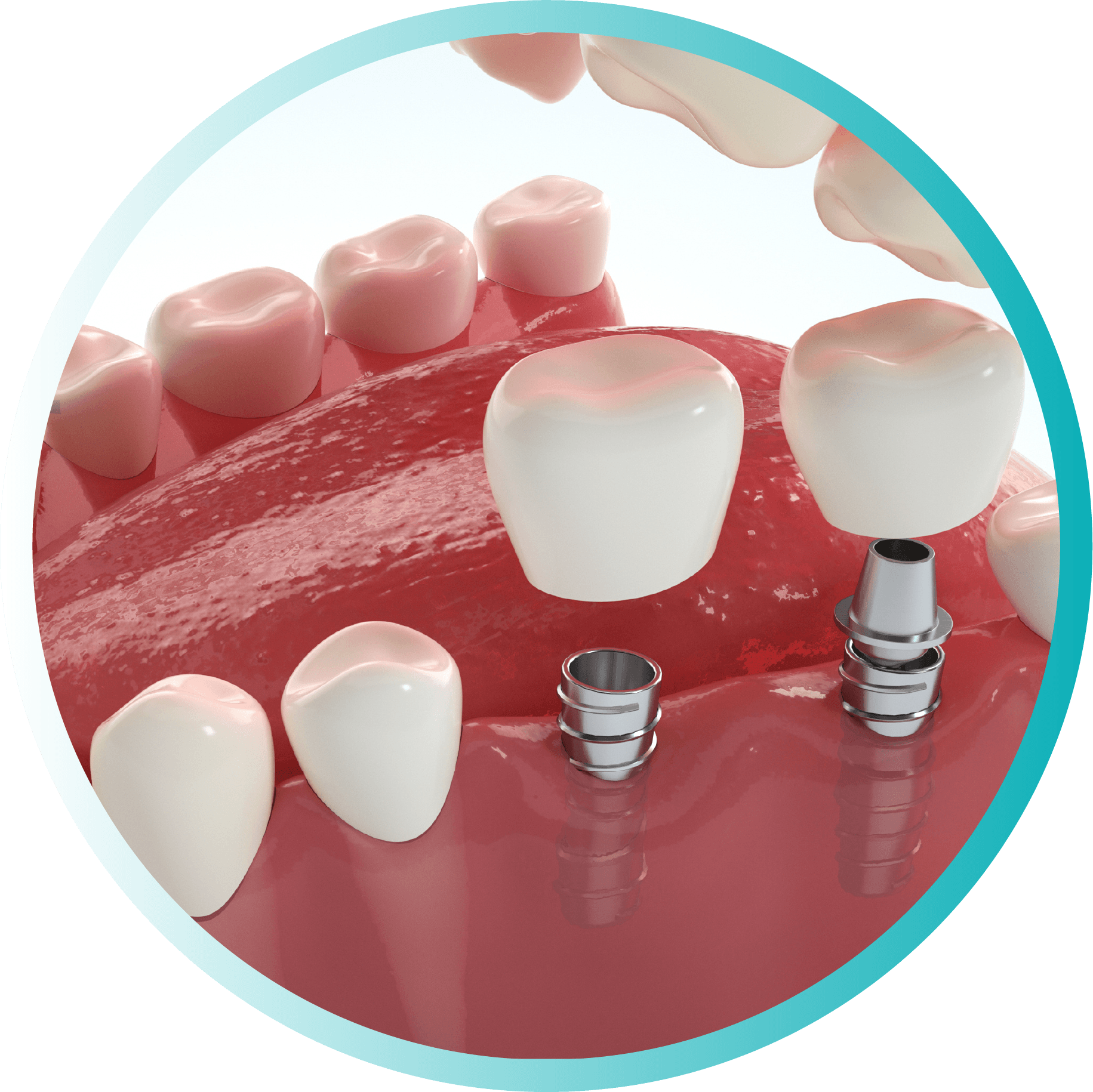 implantes dentales@300x-8 implantes dentales@300x-8